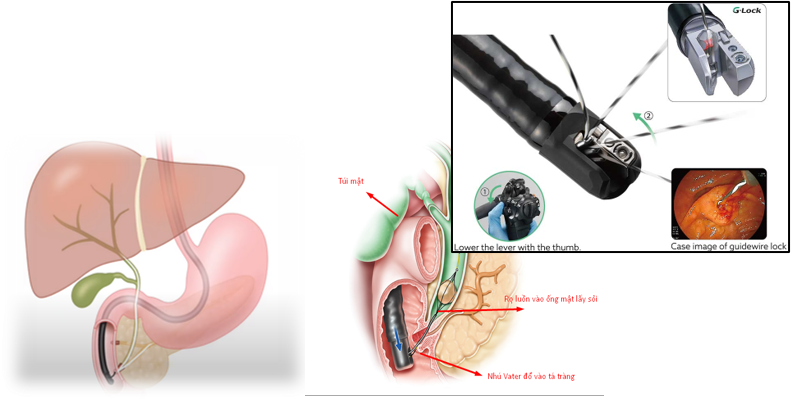 HỆ THỐNG NỘI SOI MẬT TỤY NGƯỢC DÒNG ERCP